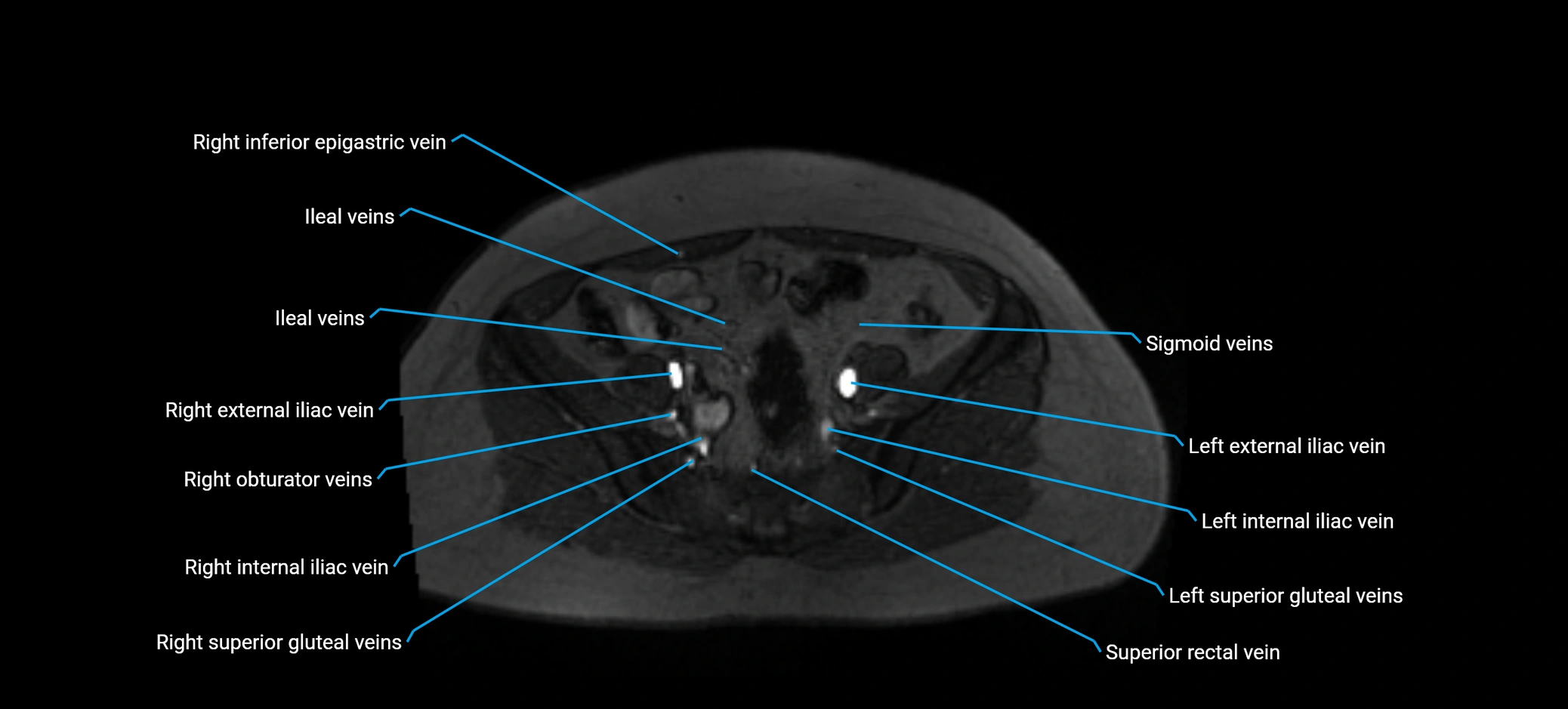MRV abdomen pelvis & lower limb axial cross sectional anatomy labelled MRI image 141 (1).webp